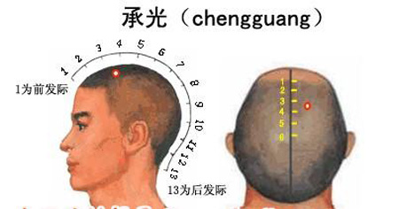 承光穴→治頭痛、鼻炎
