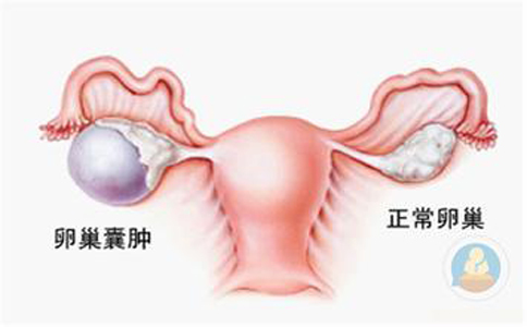 卵巢囊腫，抱腿壓涌泉穴，給你愛(ài)心呵護(hù)