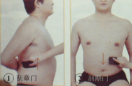 胃、十二指腸潰瘍—刮痧