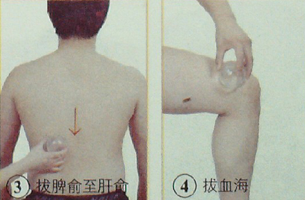胃、十二指腸潰瘍的拔罐療法